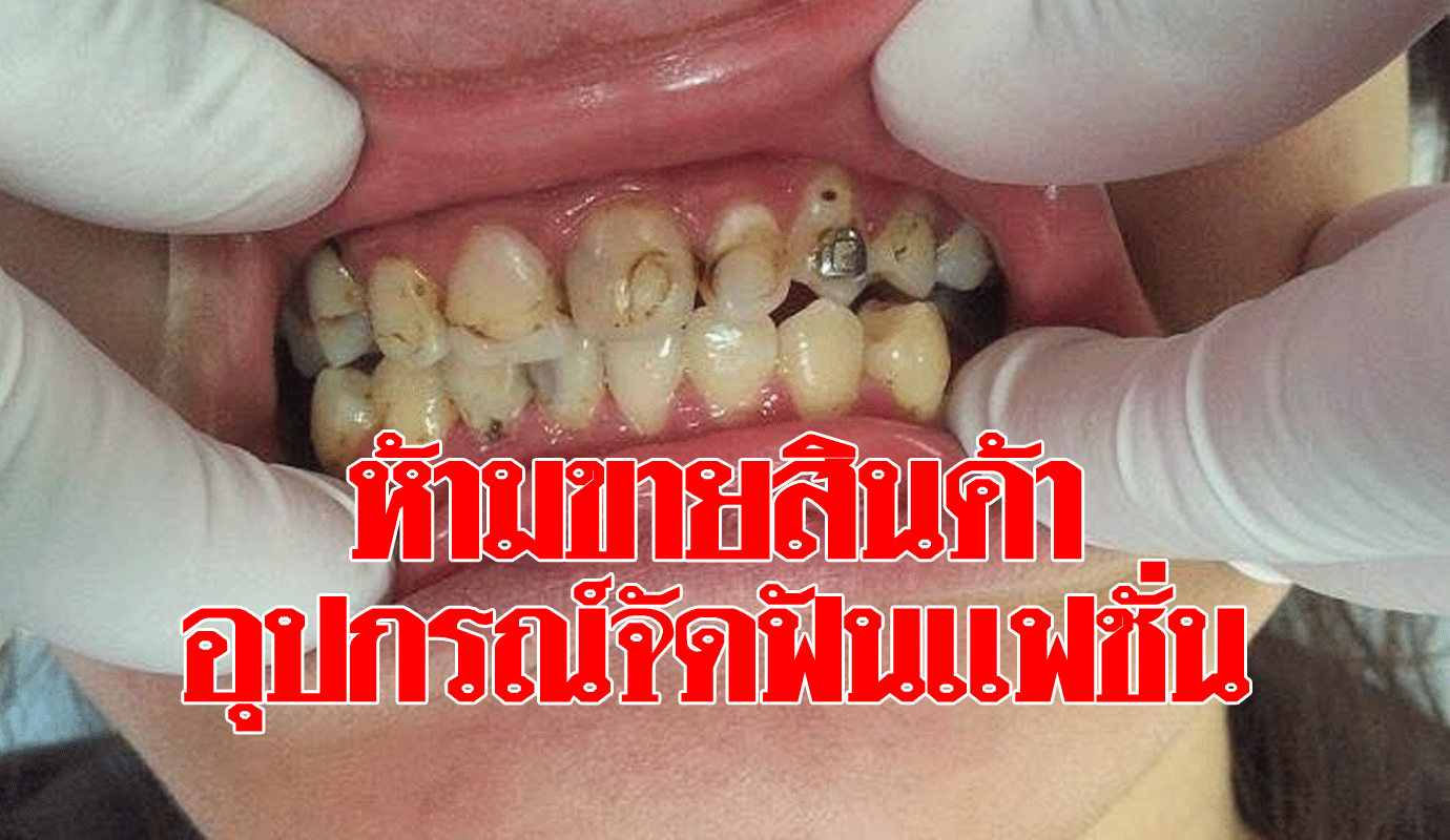 บังคับใช้แล้ว!! ราชกิจจาฯเผยแพร่คำสั่งห้ามขายสินค้าอุปกรณ์จัดฟันแฟชั่น -  ข่าวสด