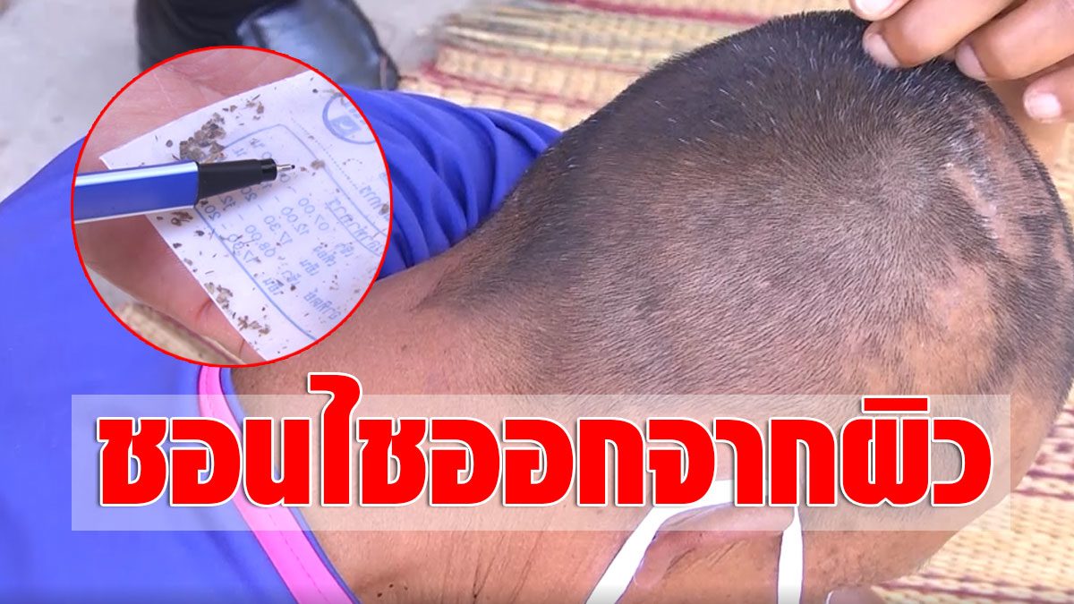 A disabled man with a strange illness  There are insects penetrating the scalp and skin.  Rud visits the cause.