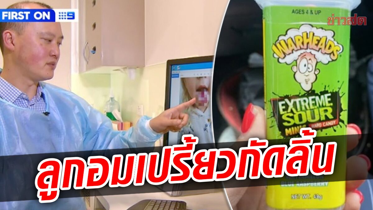 อุทาหรณ์ 4 ขวบกินลูกอม “รสเปรี้ยวจัด” กรดกัดลิ้น หนังลอก-เป็นแผลเหวอะ