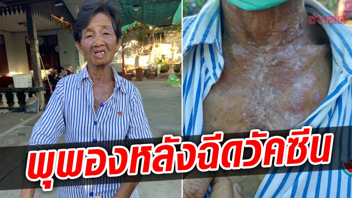 ตุ่มพองขึ้นเต็มตัว หลังฉีดวัคซีน ยายวัย 71 แสบร้อนสุดทรมาน ตาเริ่มมีอาการ หวั่นมองไม่เห็น