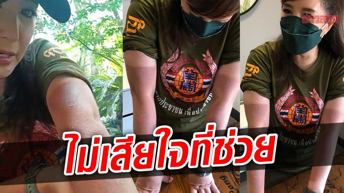 ต่าย สายธาร โชว์ความแสบทรมานทั้งแขน เผยความรู้สึกทำเพื่อแตงโม