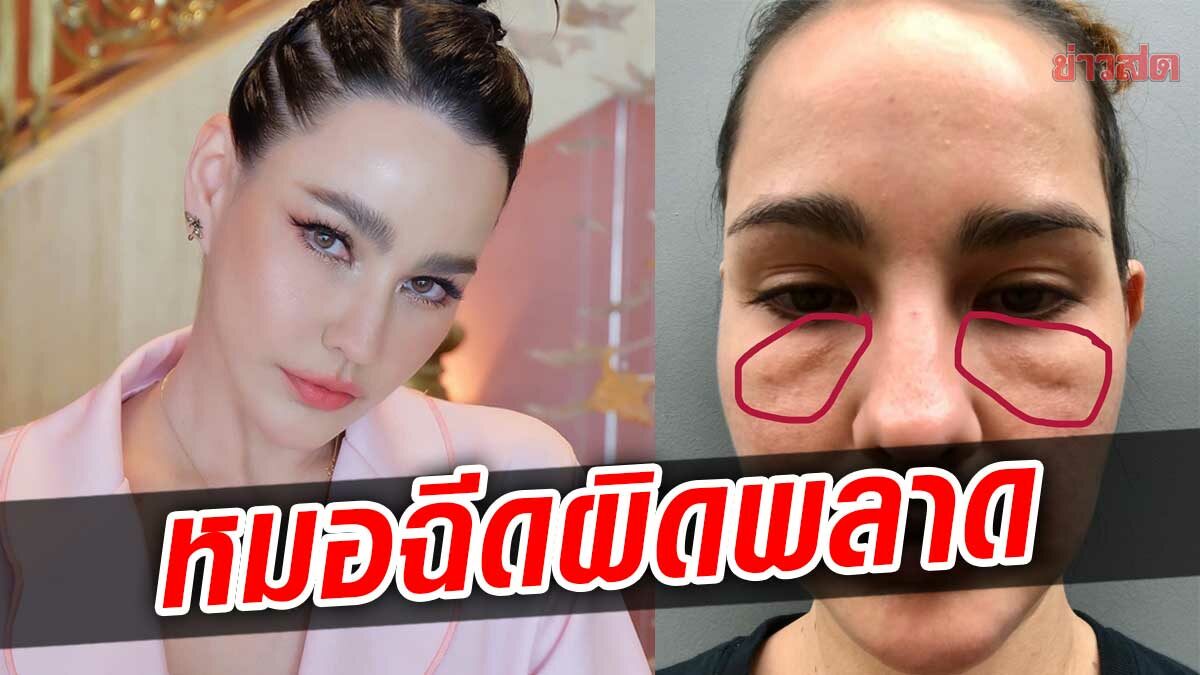 แหม่ม วิชุดา โชว์สภาพหน้า หมอฉีดไขมันใต้ตาผิดพลาด หน้าพังเพราะห่วย