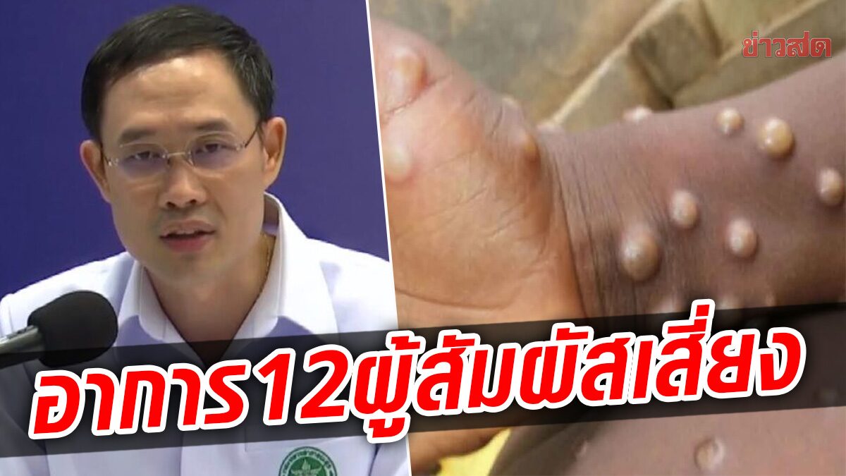 เผยอาการ 12 ผู้สัมผัส 'ผู้ป่วยฝีดาษลิง' ชี้วัคซีนยังจำเป็นหรือไม่ ใครบ้างต้องฉีด