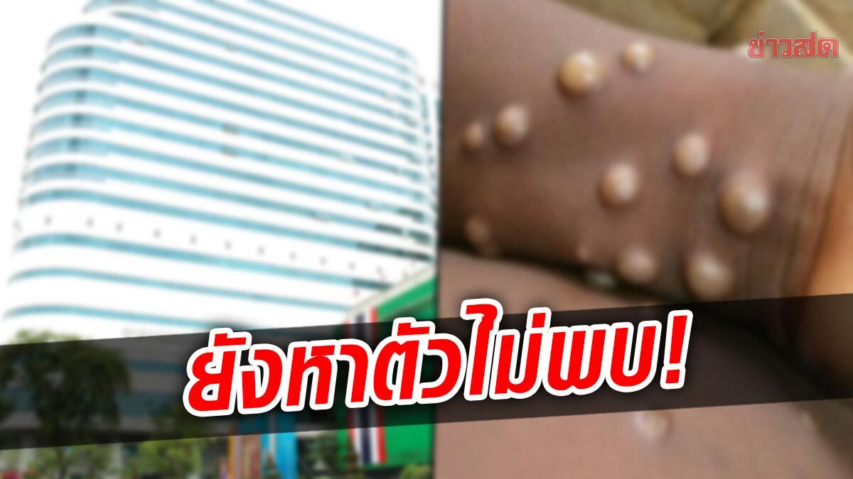 เสี่ยงเพิ่มเป็น 16 คน สัมผัสผู้ป่วย "ฝีดาษลิง" เร่งหาตัวคู่นอนต่างชาติ