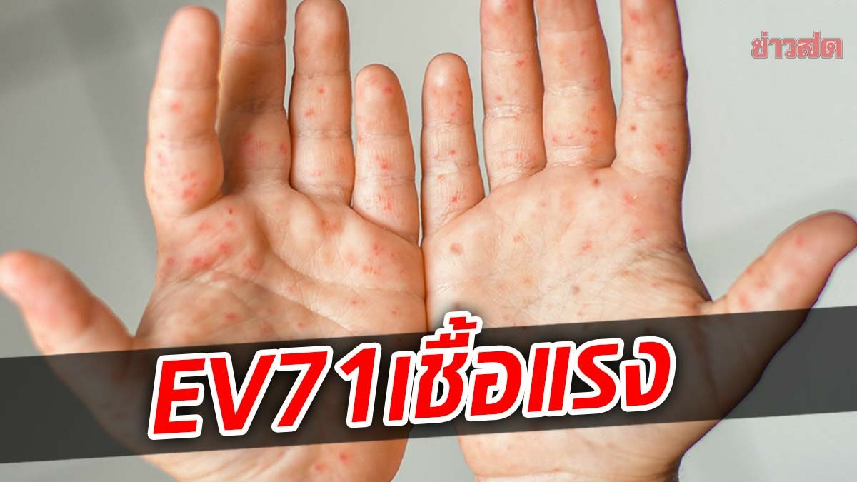 หมอแล็บแพนด้า เตือน มือเท้าปากระบาด ชี้ EV71รุนแรงทำเด็กสมองอักเสบได้