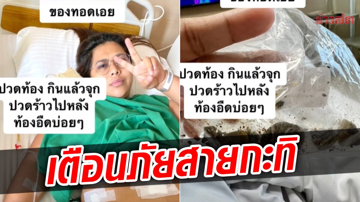 อันตรายถึงชีวิต! สาวโพสต์สายกะทิต้องระวัง เจอนิ่วในถุงน้ำดี มีอาการแบบนี้พบหมอด่วน