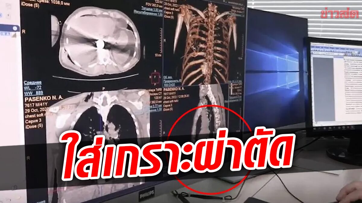 หมอรัสเซีย ใส่ชุดเกราะผ่าตัดคนไข้ หลังอีกฝ่ายเป็นทหารที่มีระเบิดฝังในตัว