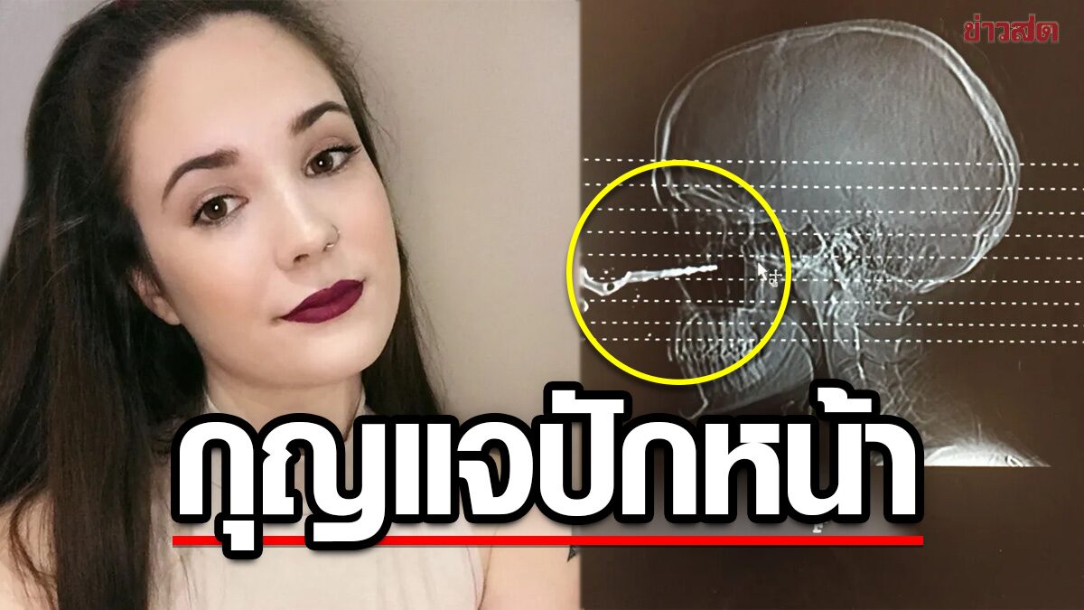 สาวแคนาดา “หวิดบอด” เพื่อนโยนกุญแจรถแรงไปหน่อย “ปักหน้า” คาใกล้ดวงตา