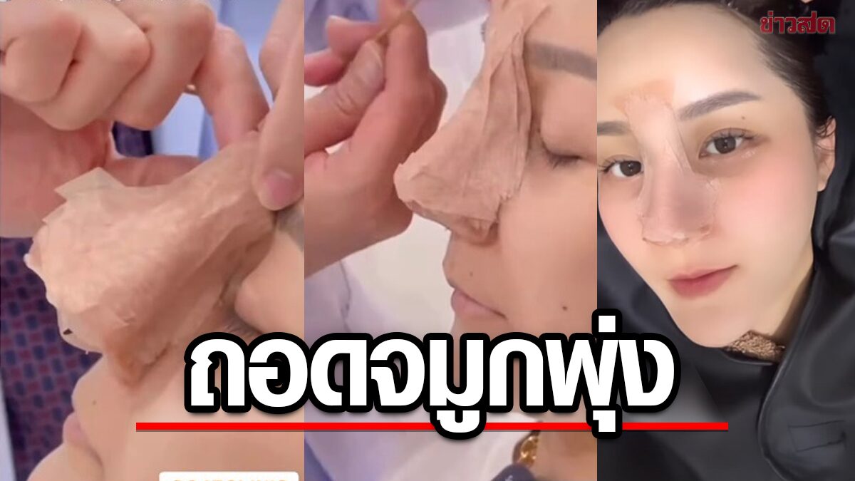 หน้าเดียวมา7วัน เอ็ม บุษราคัม ดีใจถอดเฝือกจมูกใหม่สวยพุ่ง ลุ้นตัดไหมฟื้นตัวเร็ว