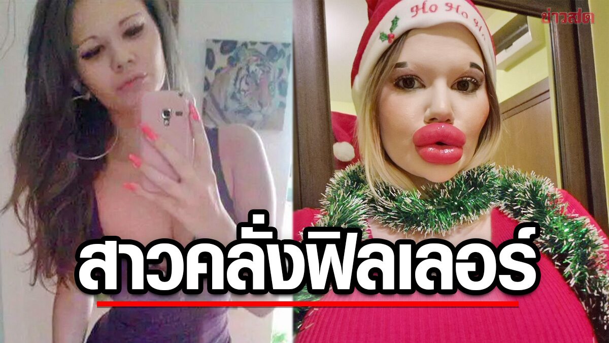 สาวคลั่งฟิลเลอร์มั่นใจ “ปากอิ่มสุดในโลก” หวังคว้าอีกตำแหน่ง “คางแหลมพุ่ง”